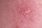 Herpes - symptoms, causes, types, ways of transmission of the virus, treatment and prevention Herpes from what it happens and what