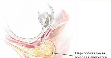 دلایل ایجاد کیسه زیر چشم