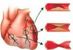 Ішемічна хвороба серця клініка та діагностика